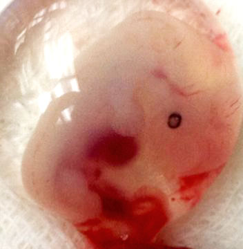 5 week embryo - ectopic pregnancy