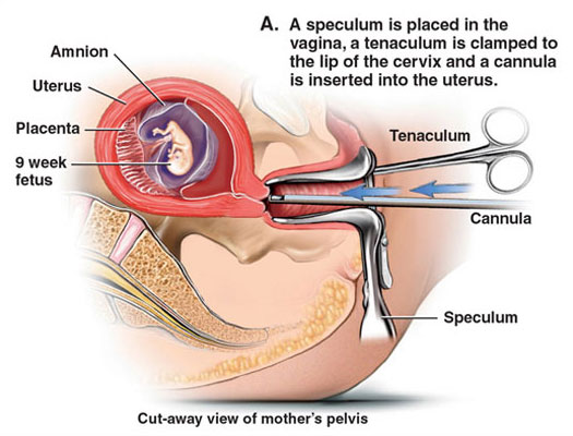 Suction Abortion Illustration - 01