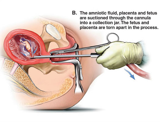 Suction Abortion Illustration - 02
